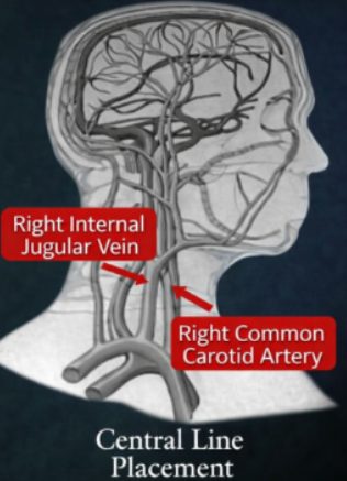 CENTRAL LINE PLACEMENT