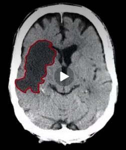 CT SCAN OF CHESTA SHOEMAKER