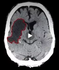 CT scan of Chesta Shoemaker