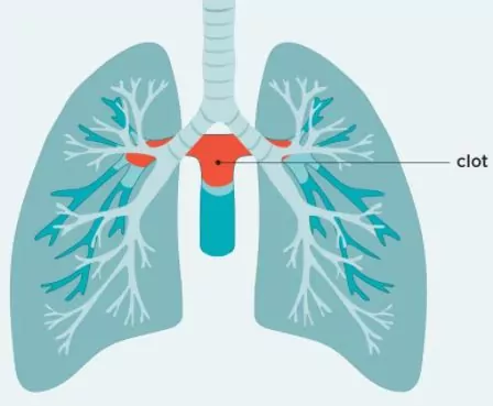Saddle Pulmonary Embolism
