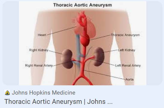 Thoracic Aortic Aneurysm (TAA)