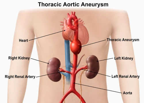 Thoracic Aortic Aneurysm